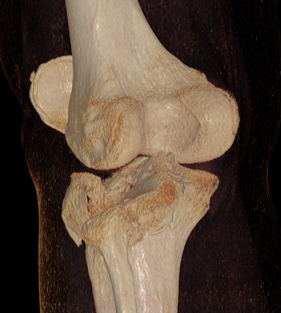 Posterolateral Tibial Plateau